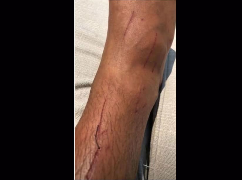 Aarón Díaz mostró su herida en redes sociales