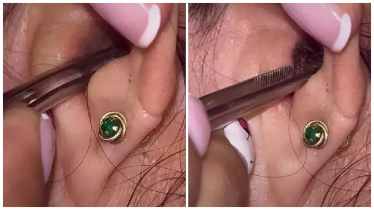 Joven descubre insecto en su oreja.